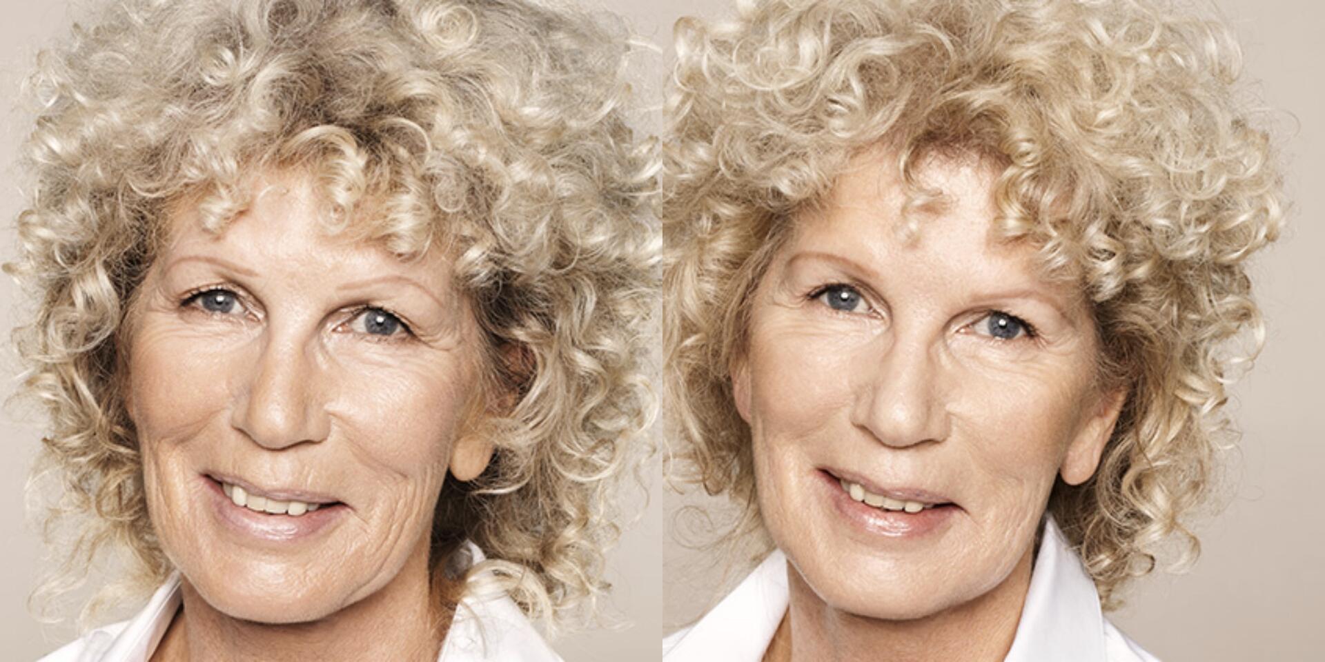 Before and After Image: Restylane - left-front-oblique