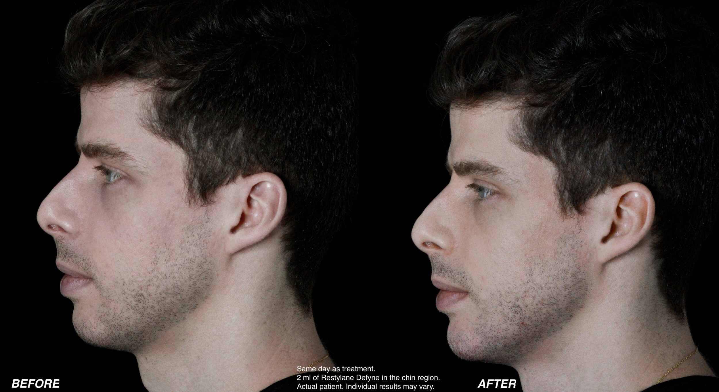 Before and After Image: Restylane - left-side