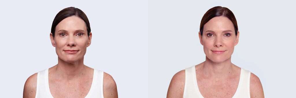 Before and After Image: Restylane - front