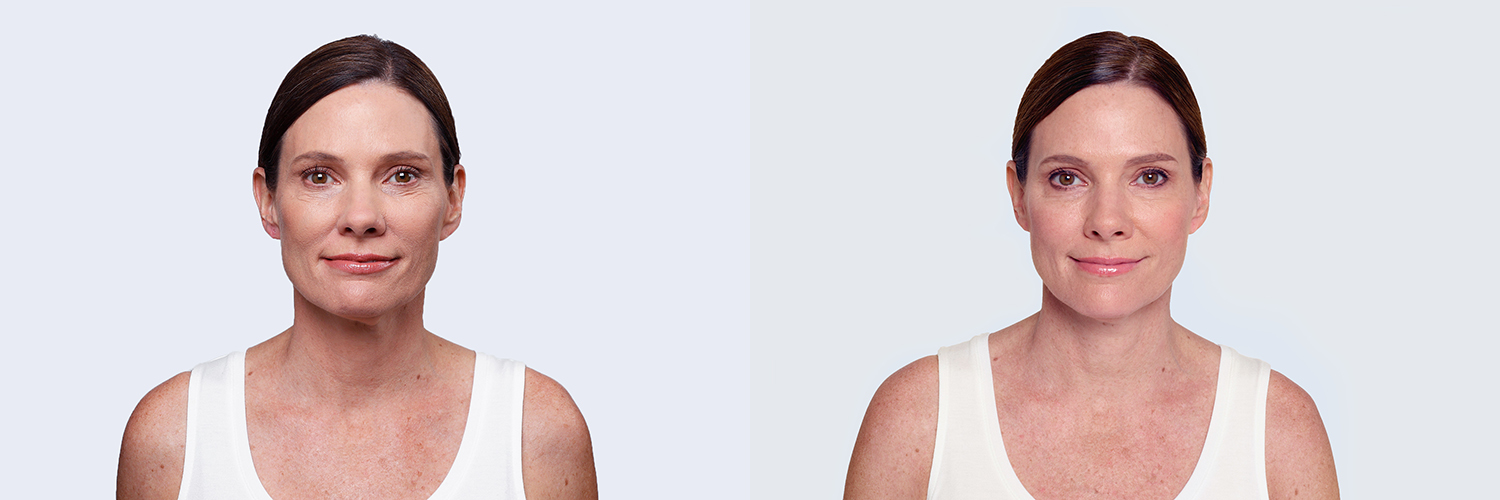 Before and After Image: Restylane - front