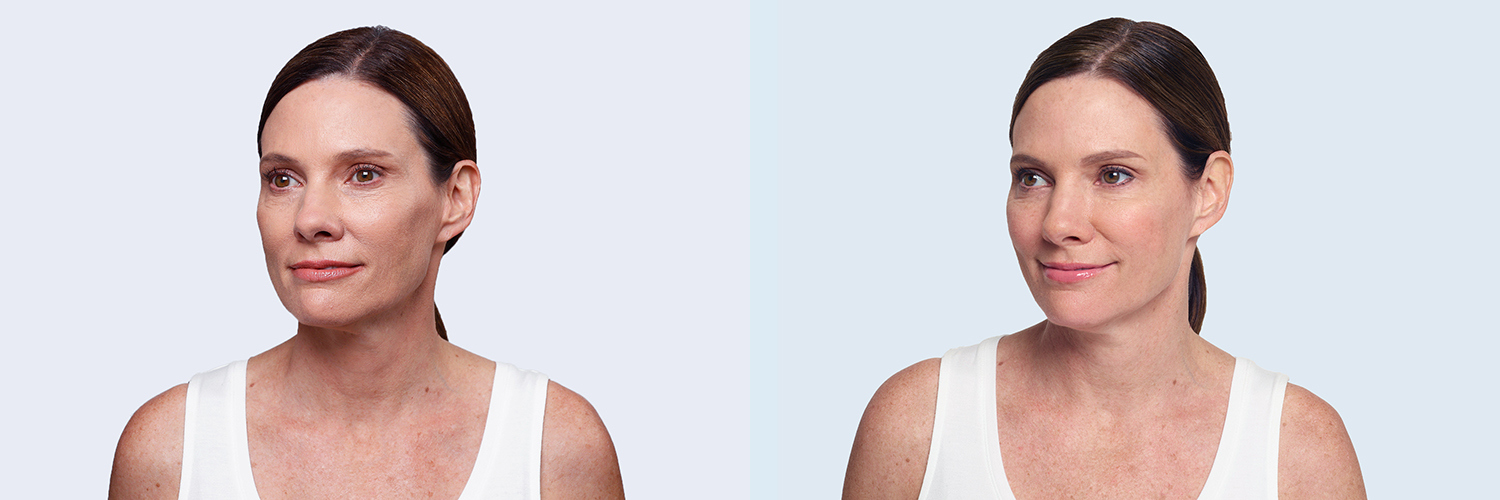Before and After Image: Restylane - left-front-oblique