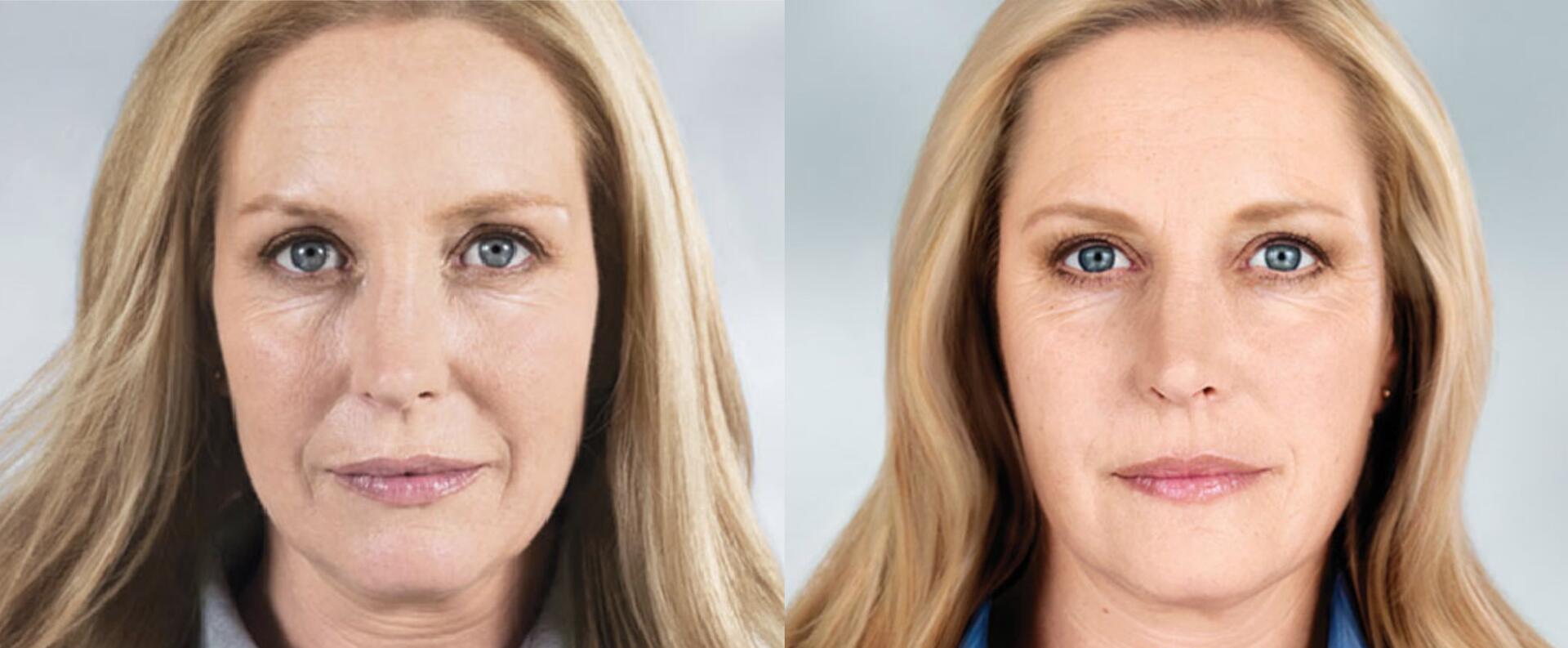 Before and After Image: Sculptra - front