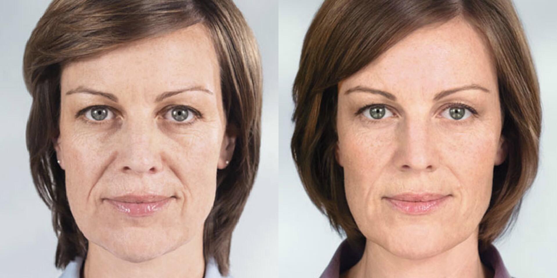 Before and After Image: Sculptra - front
