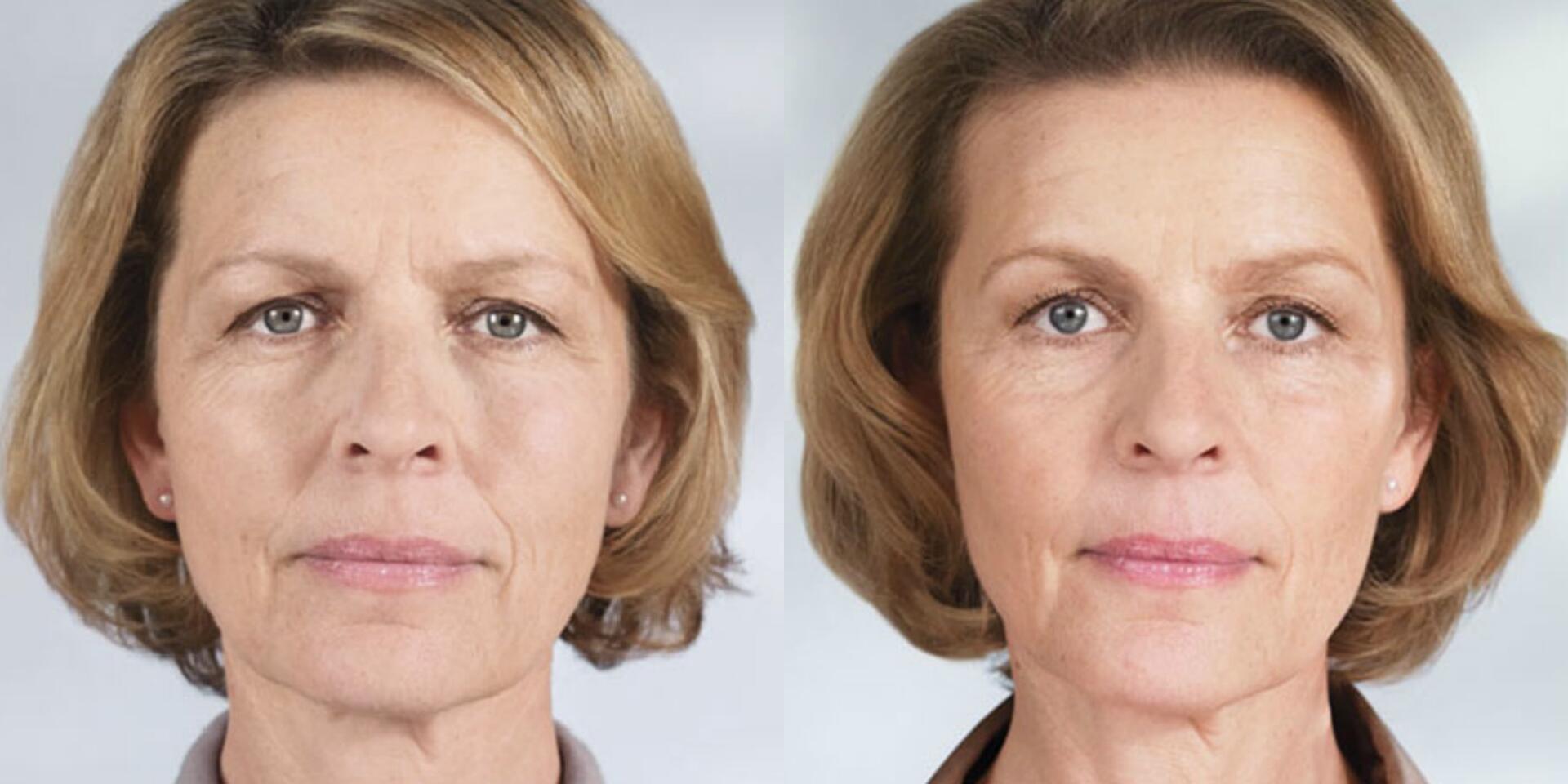 Before and After Image: Sculptra - front