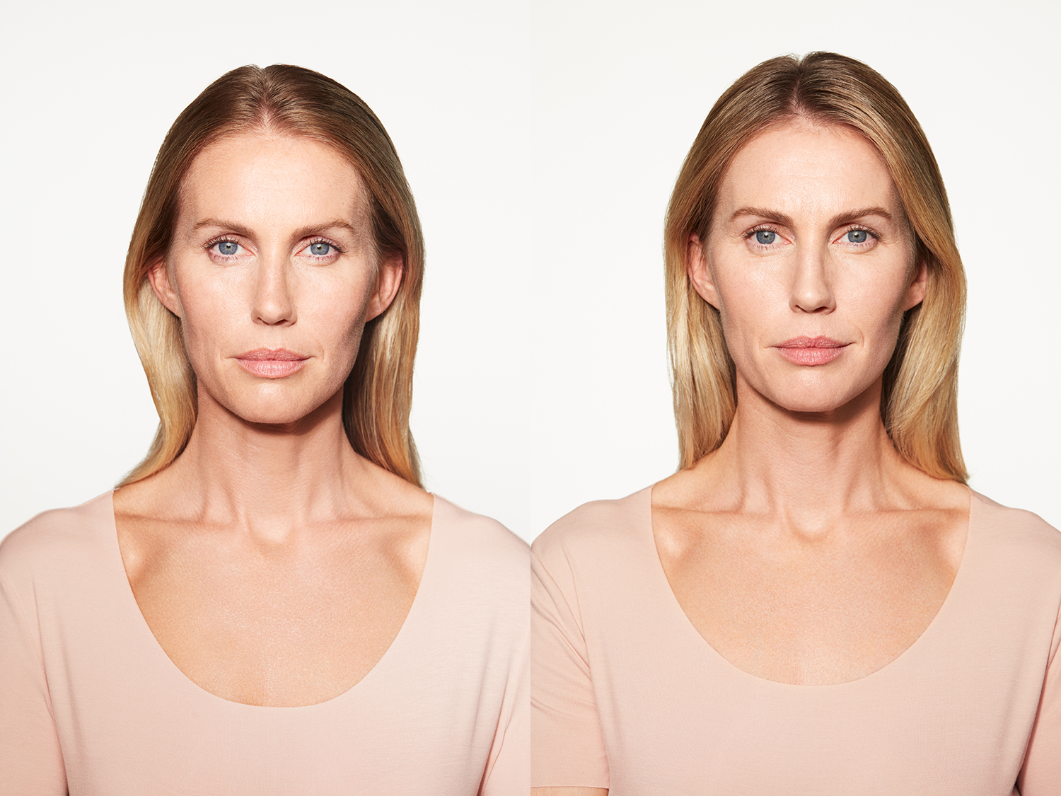 Before and After Image: Sculptra - front