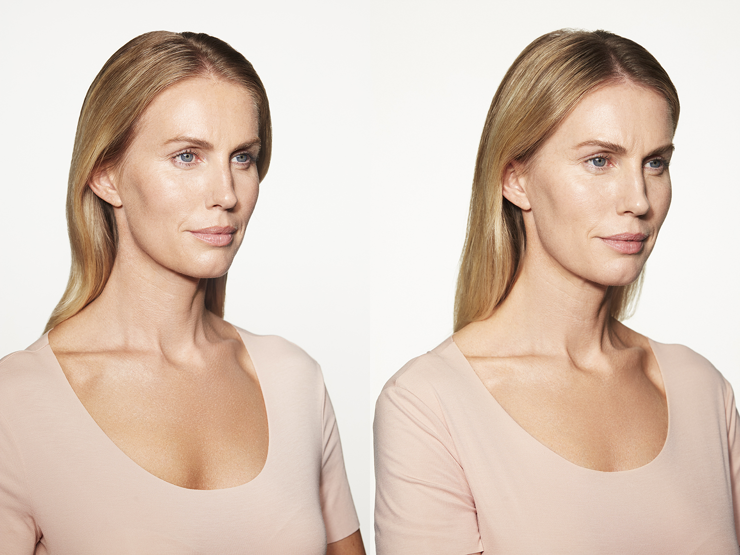 Before and After Image: Sculptra - right-front-oblique