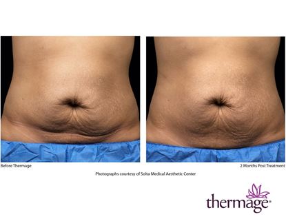 Before and After Image: Thermage - front