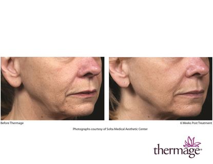 Before and After Image: Thermage - right-front-oblique