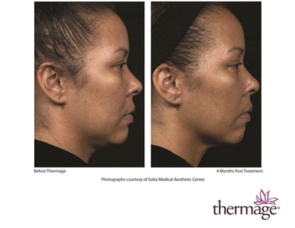 Before and After Image: Thermage - right-side