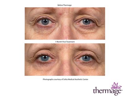Before and After Image: Thermage - front