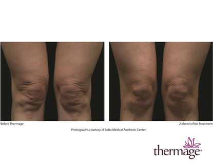 Before and After Image: Thermage - front