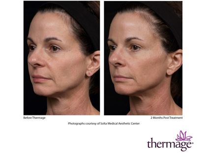 Before and After Image: Thermage - left-front-oblique
