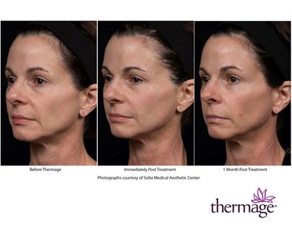 Before and After Image: Thermage - left-front-oblique