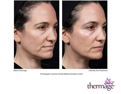 Before and After Image: Thermage - right-front-oblique