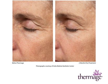 Before and After Image: Thermage - left-front-oblique