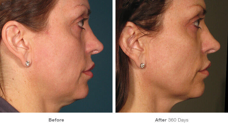 Before and After Image: Ultherapy - right-side