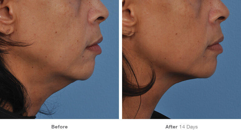 Before and After Image: Ultherapy - right-side