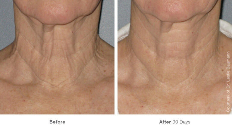 Before and After Image: Ultherapy - front