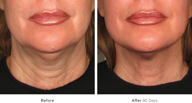 Before and After Image: Ultherapy - front