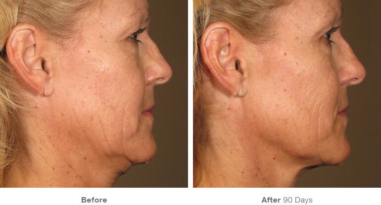 Before and After Image: Ultherapy - right-front-oblique