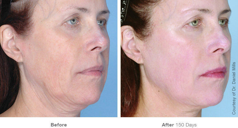 Before and After Image: Ultherapy - right-front-oblique