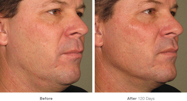 Before and After Image: Ultherapy - right-front-oblique