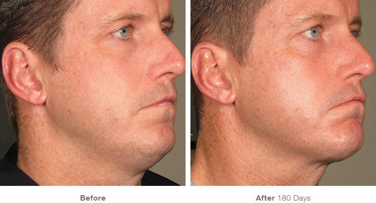 Before and After Image: Ultherapy - right-front-oblique