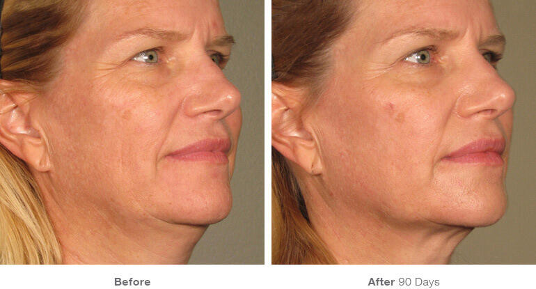 Before and After Image: Ultherapy - right-front-oblique