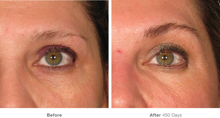Before and After Image: Ultherapy - front