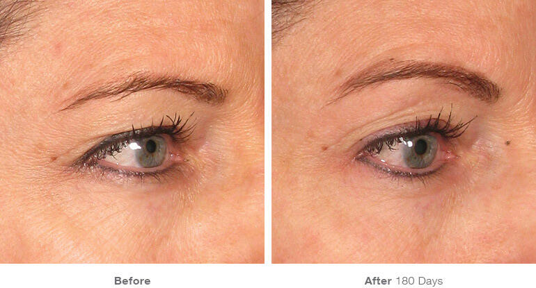 Before and After Image: Ultherapy - right-front-oblique