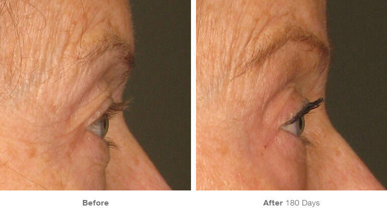 Before and After Image: Ultherapy - right-side