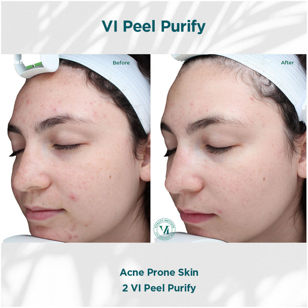 Before and After Image: VI Peel - left-front-oblique