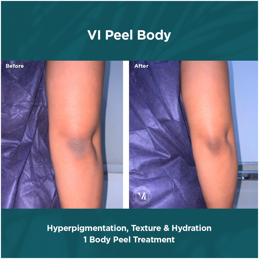 Before and After Image: VI Peel - back