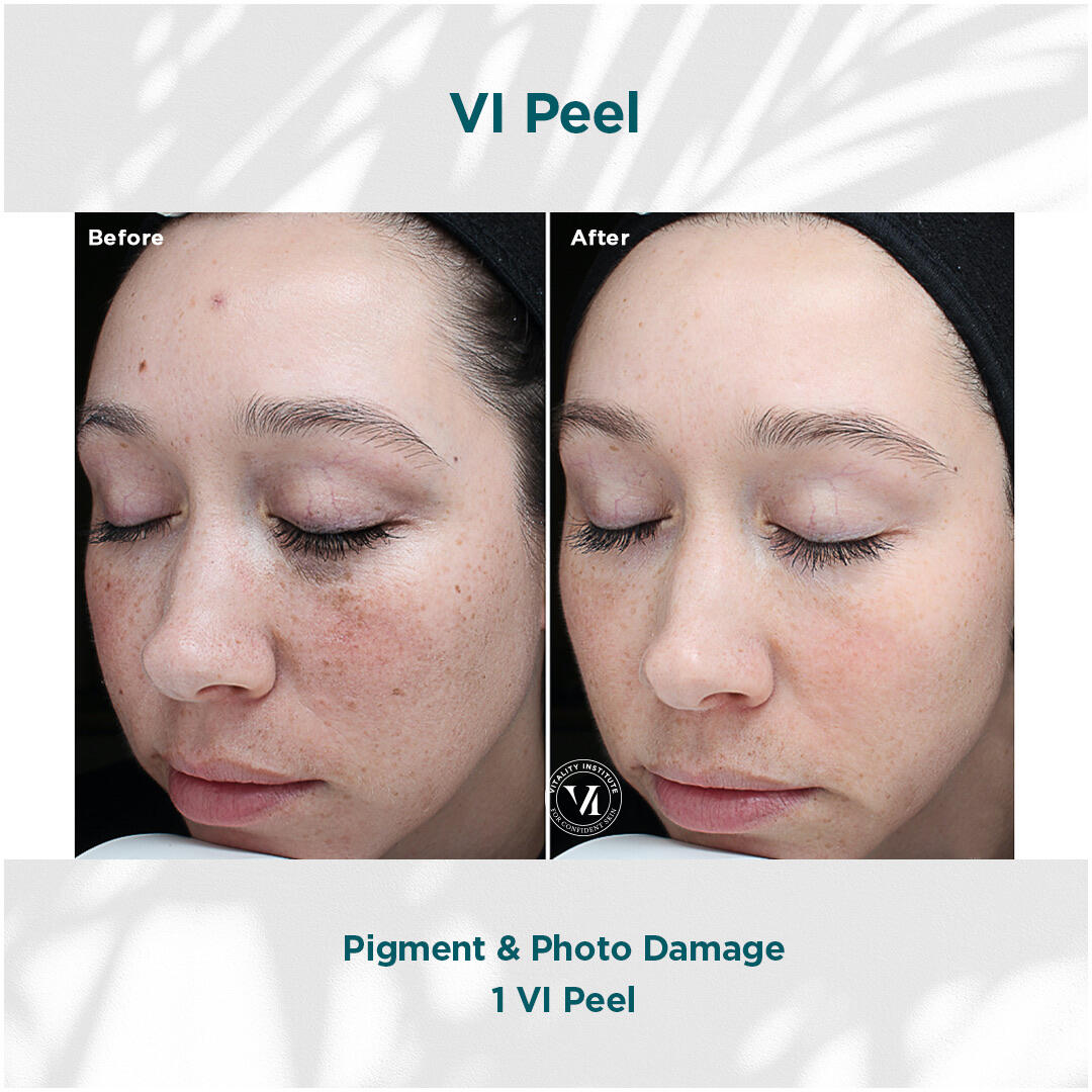 Before and After Image: VI Peel - left-front-oblique