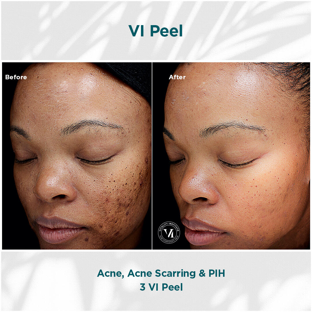 Before and After Image: VI Peel - left-front-oblique