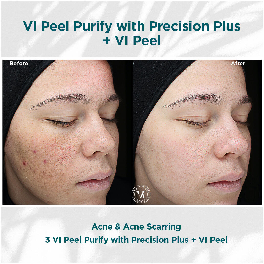 Before and After Image: VI Peel - right-front-oblique