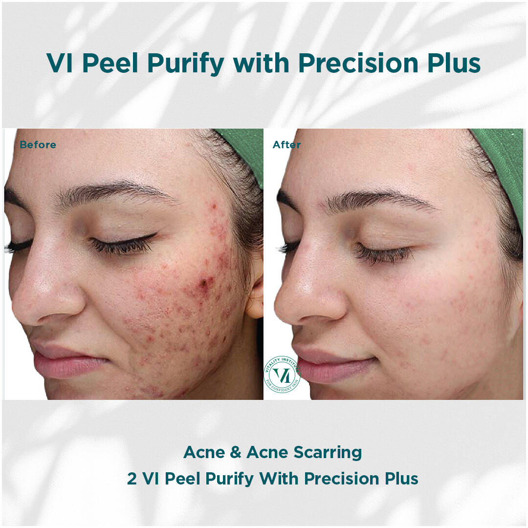 Before and After Image: VI Peel - left-front-oblique
