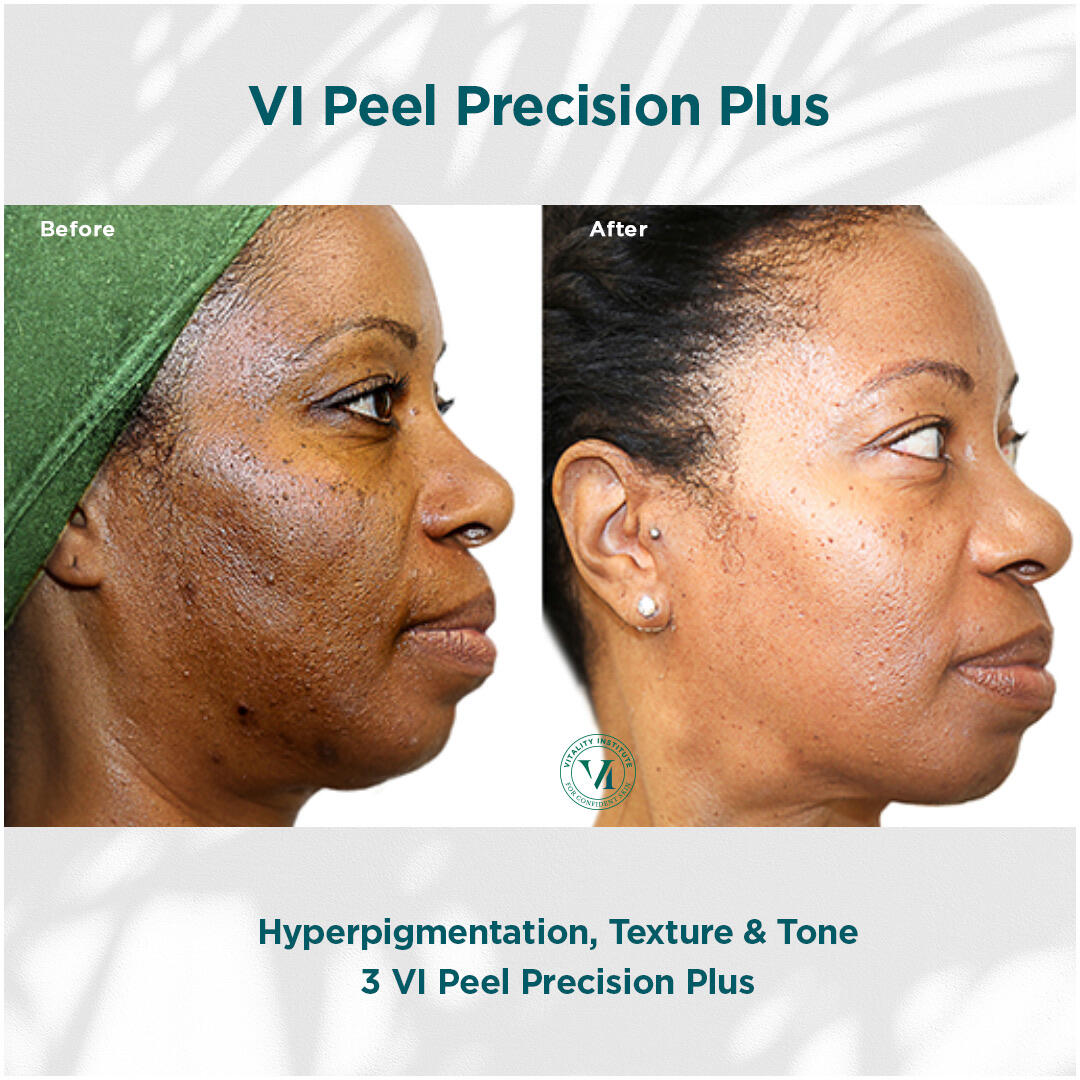 Before and After Image: VI Peel - right-side