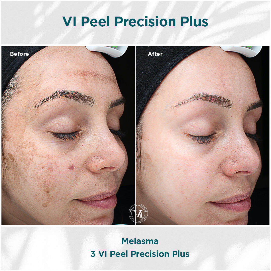 Before and After Image: VI Peel - right-front-oblique