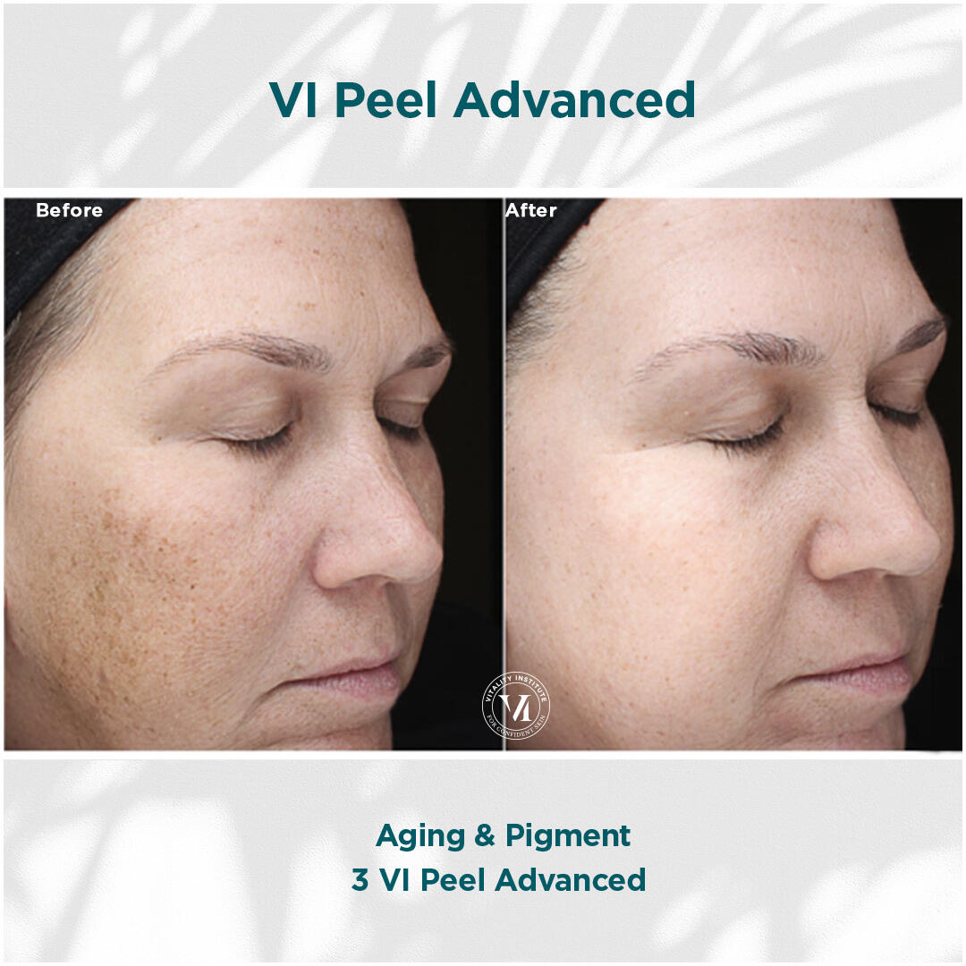 Before and After Image: VI Peel - right-front-oblique