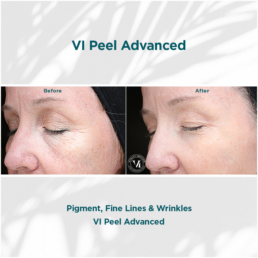 Before and After Image: VI Peel - left-front-oblique