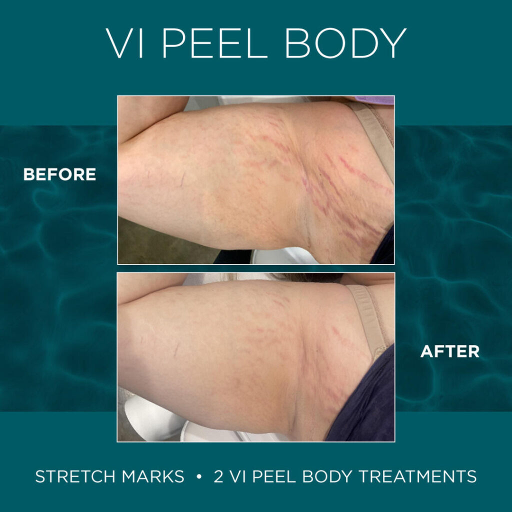 Before and After Image: VI Peel - front