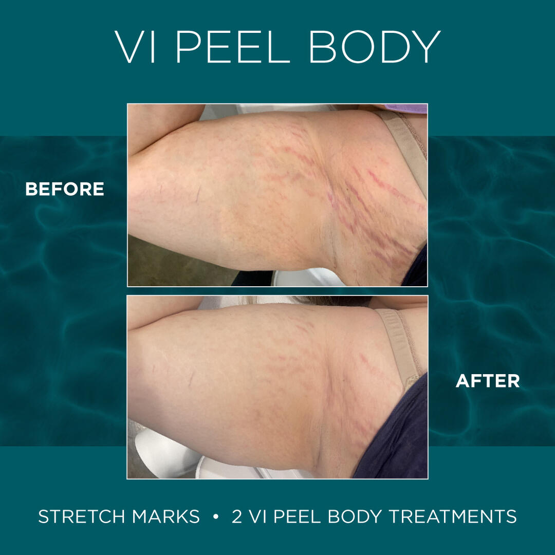 Before and After Image: VI Peel - front
