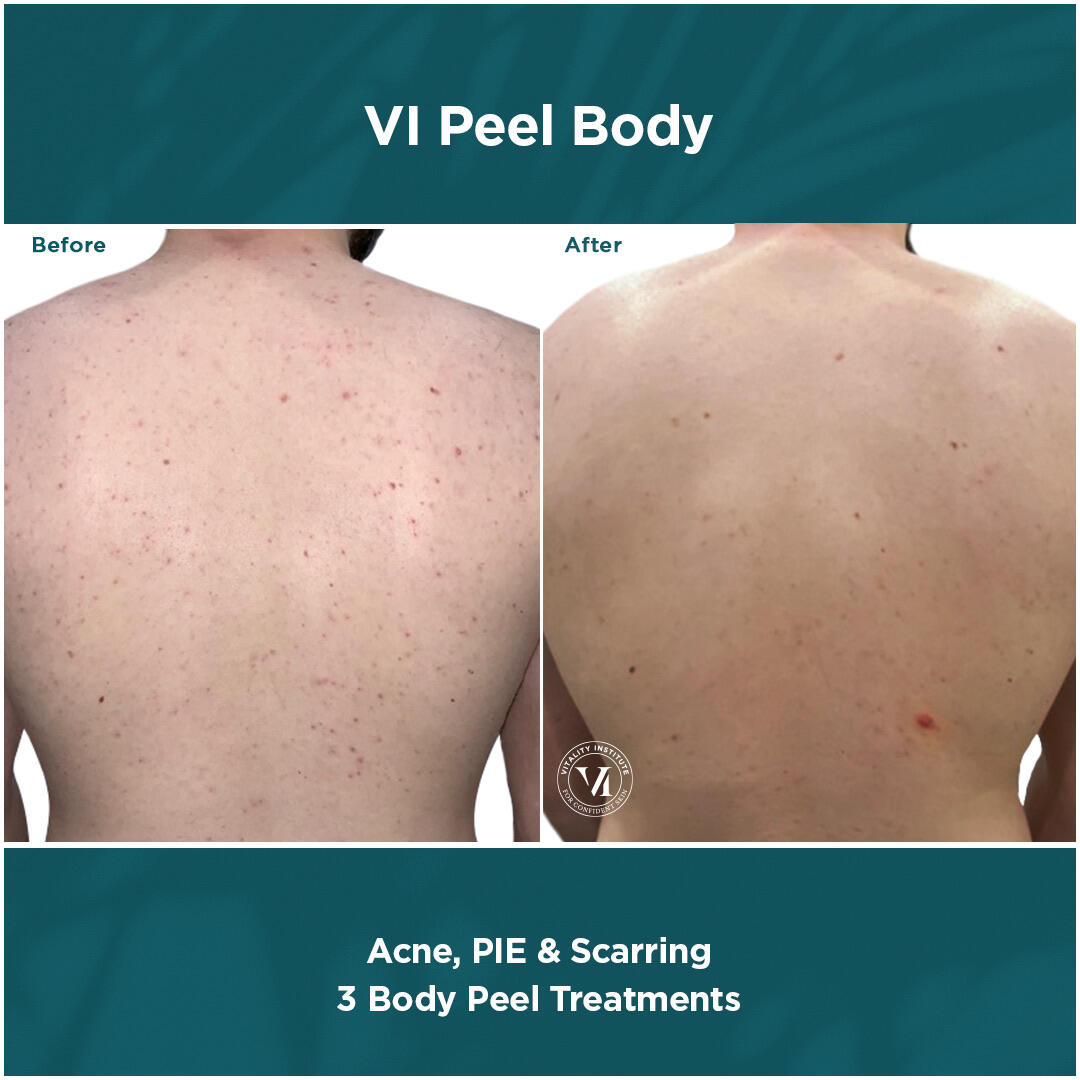 Before and After Image: VI Peel - back