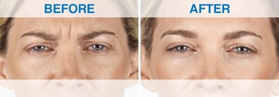 Before and After Image: Xeomin - front