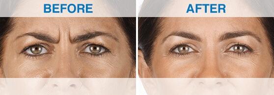 Before and After Image: Xeomin - front