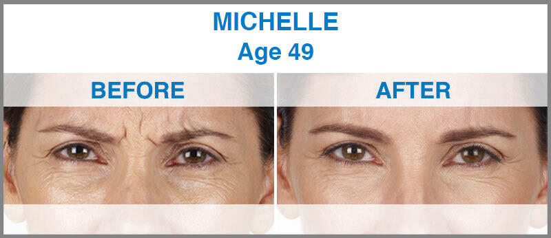 Before and After Image: Xeomin - front