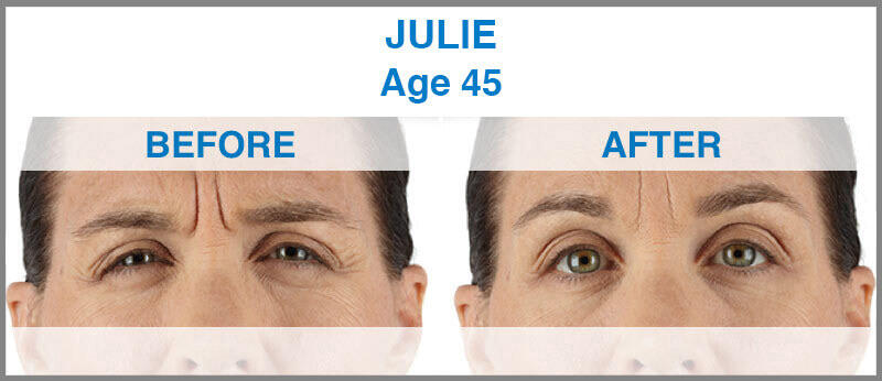 Before and After Image: Xeomin - front