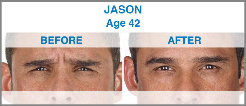 Before and After Image: Xeomin - front