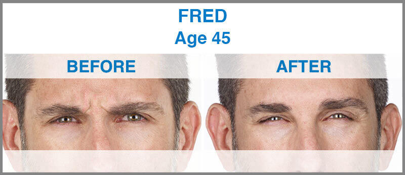 Before and After Image: Xeomin - front